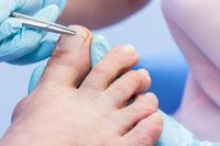 Spangentechnik in der kosmetischen Fußpflege — Nagelspange wird präzise am Zehennagel angebracht.