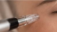 Microneedling mit dem Needling-Pen an der Augenpartie