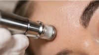 Mikrodermabrasion: Handstück mit Diamantschleifkopf glättet die Haut an der Stirn